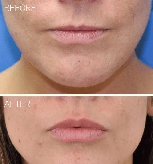 Before and after: Botox Injection