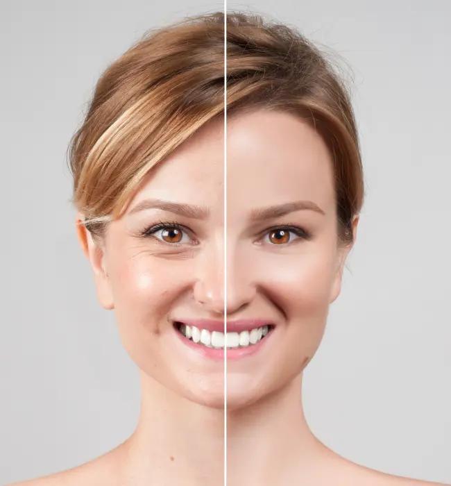 Before and after: Botox Injection