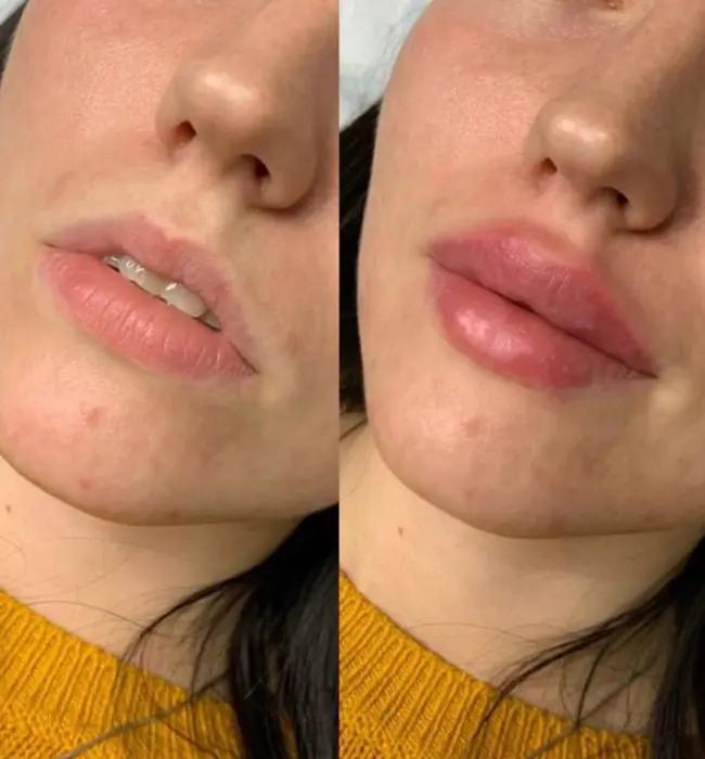 Before and after: Botox Injection