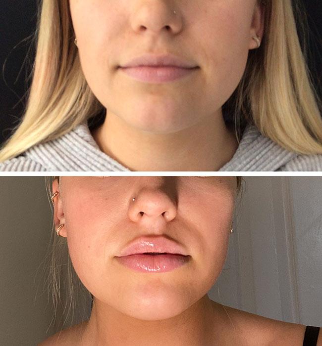 Before and after: Restylane Kysse