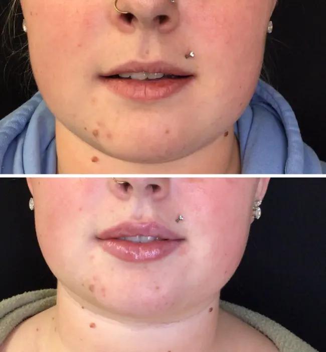 Before and after: Restylane Kysse