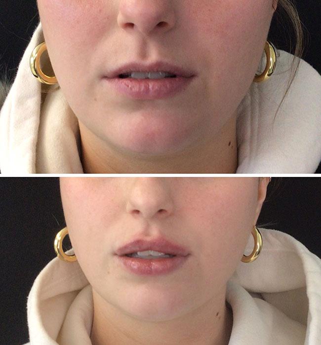 Before and after: Restylane Kysse