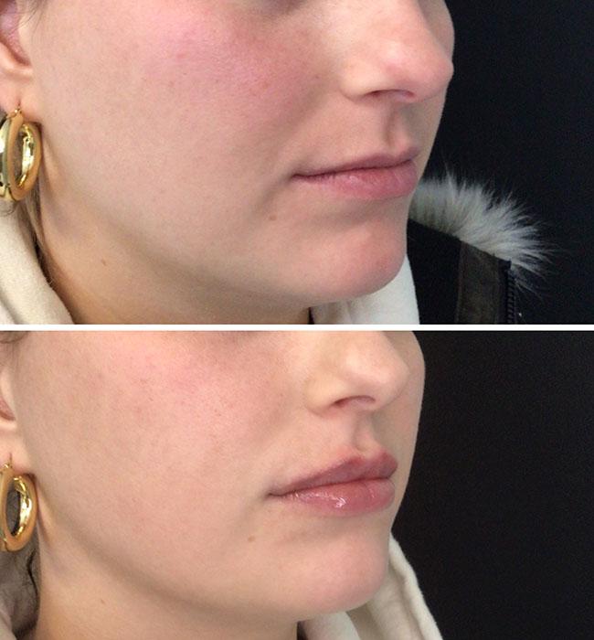 Before and after: Restylane Kysse