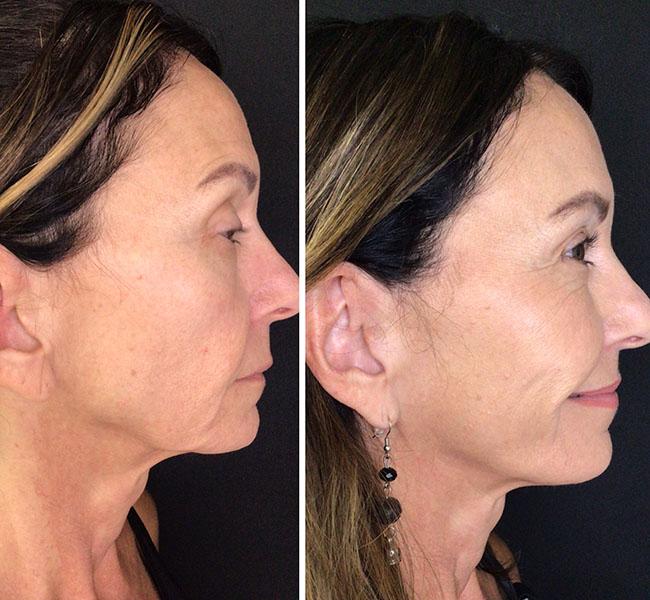 Juvederm full face filler