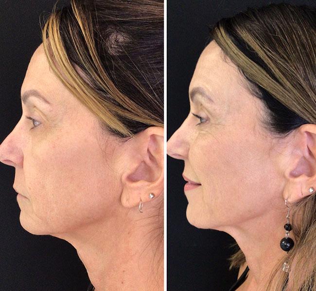 Juvederm full face filler