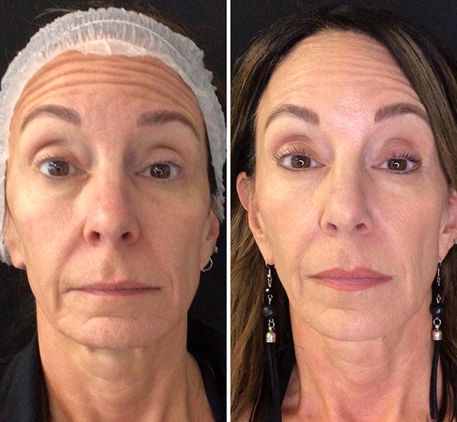 Juvederm full face filler