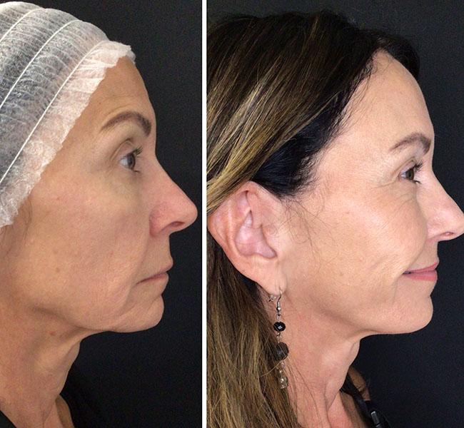 Juvederm full face filler