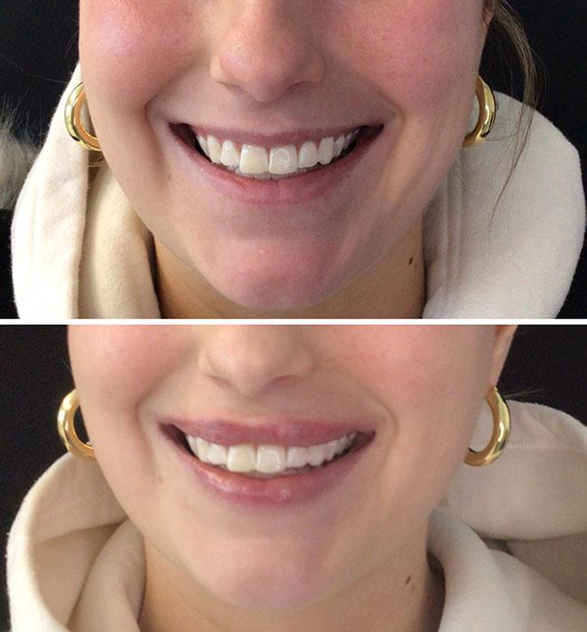 Lips filler before and after