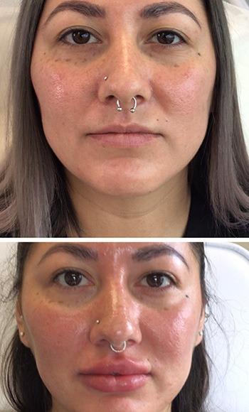 Lips filler before and after