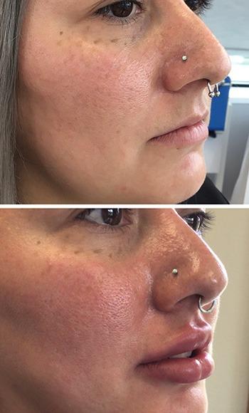 Lips filler before and after