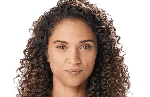 Juvederm Natasha (before)