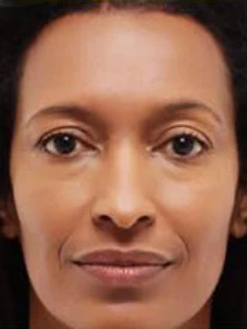 Mid cheek and lips filler 1 (after)