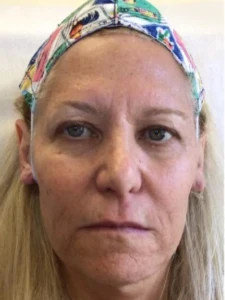 Mid cheek and lips combo (before)