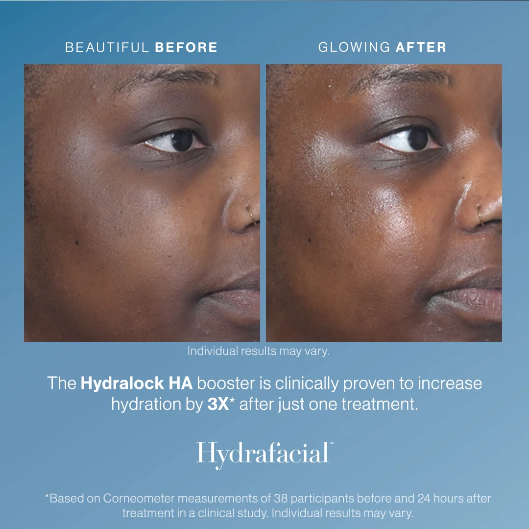 Hydralock HA booster - fine lines and wrinkles results